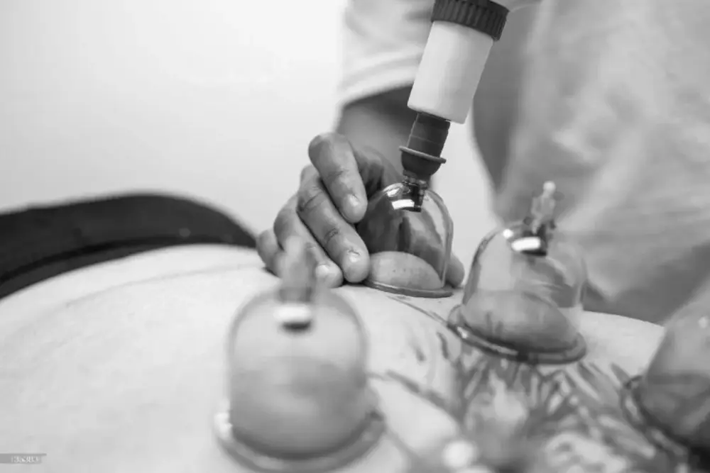 Cupping thérapie à Périgueux